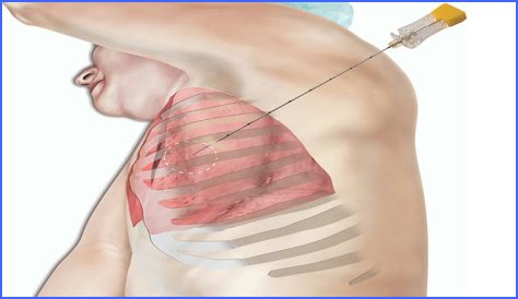 How do you feel after a lung biopsy?